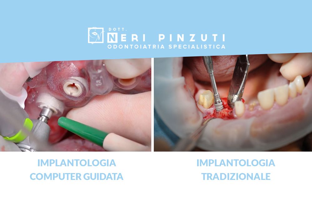 implantologia computer guidata