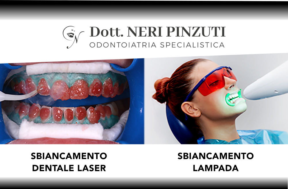 Sbiancamento dentale laser