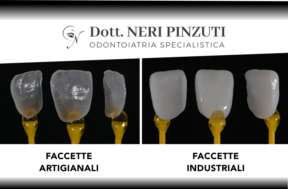 La nuova era delle faccette dentali