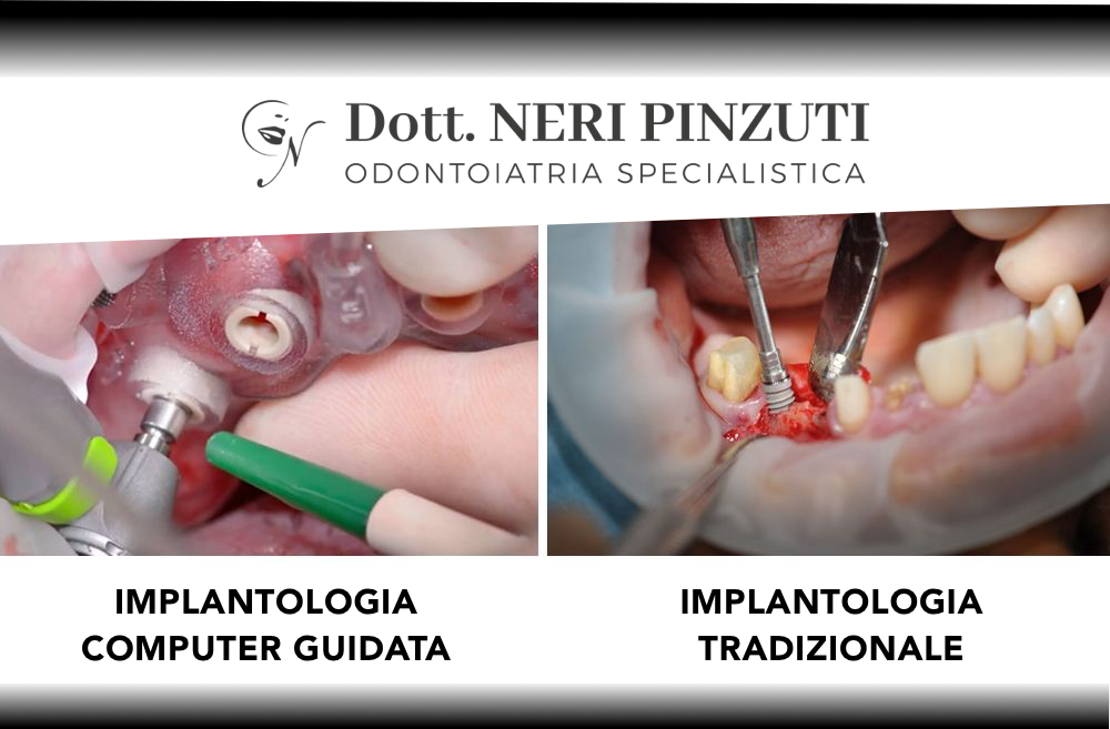 Basta bisturi con l’implantologia computer guidata minimamente invasiva