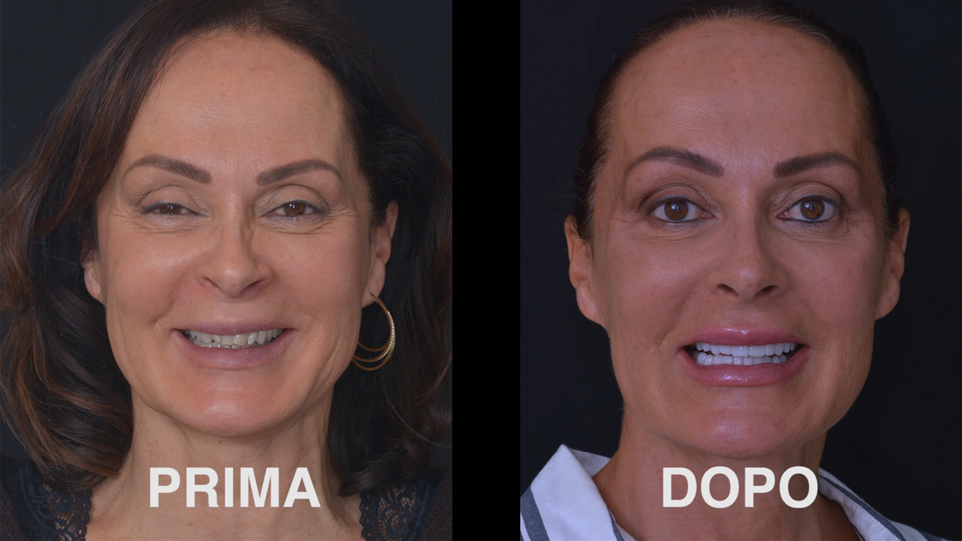 Faccette Dentali – Caso clinico Marcella
