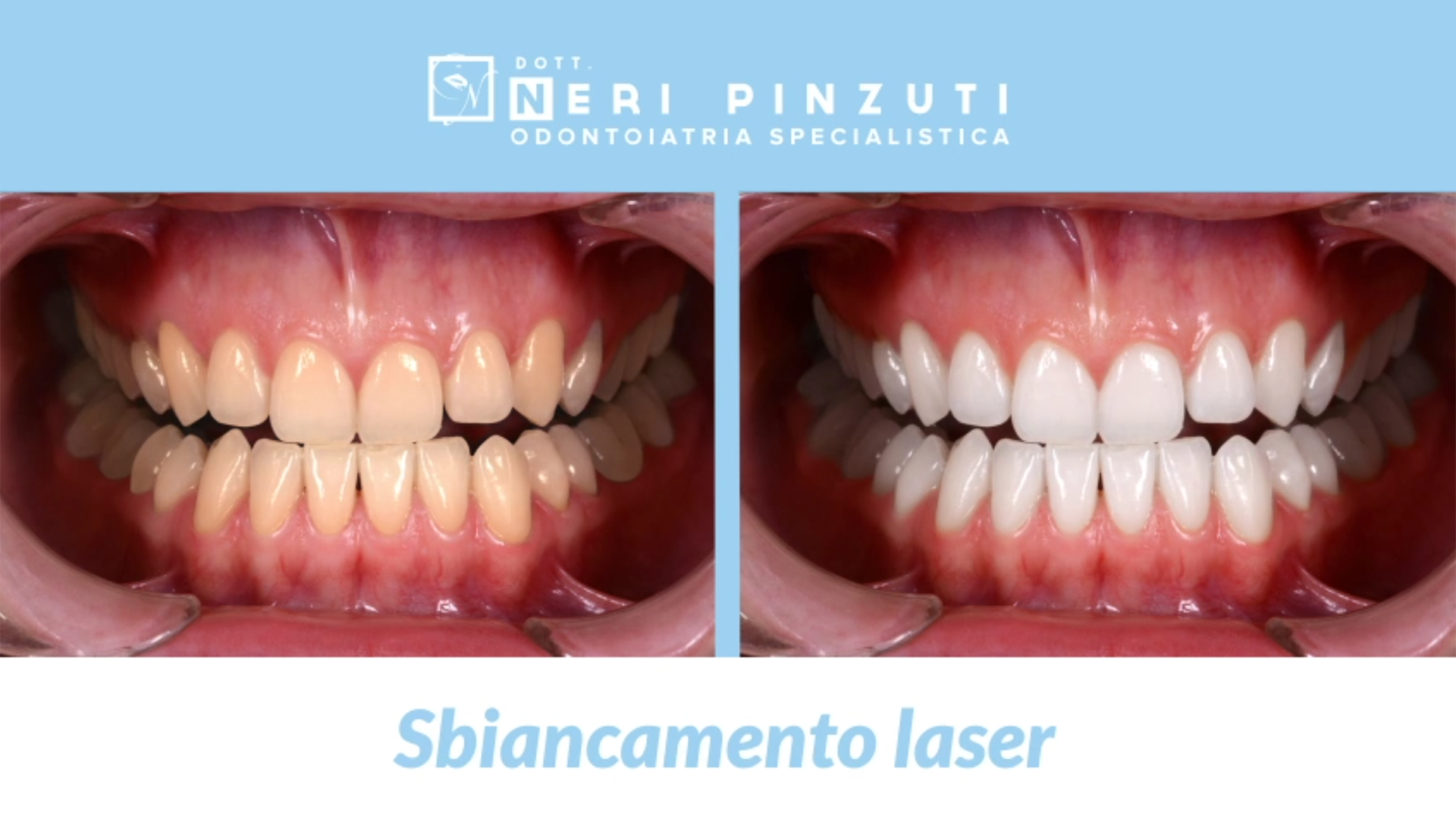 Video Sbiancamento Laser