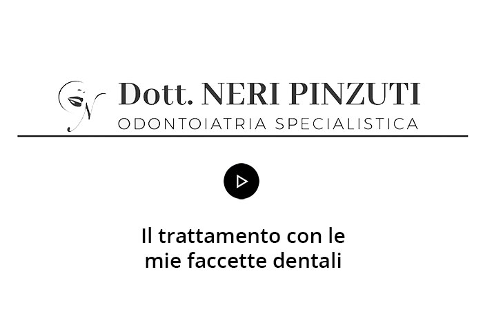 Il trattamento con le mie faccette dentali