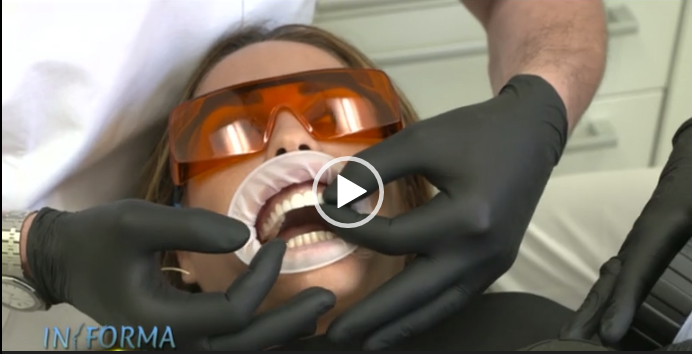 Canale 5 – In Forma – Faccette Dentali