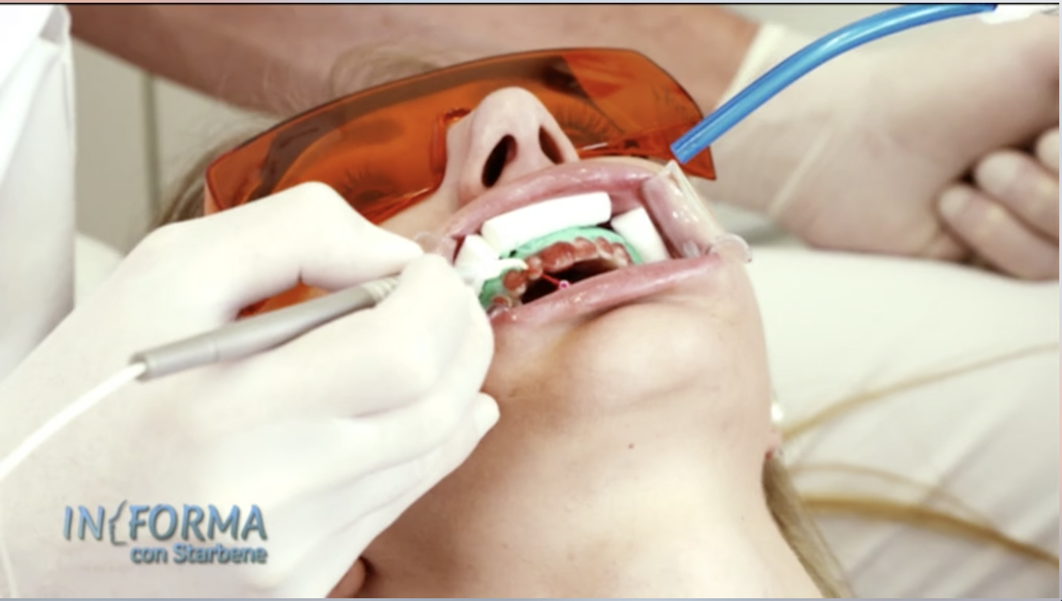 Canale 5 – In Forma – Sbiancamento Dentale Laser