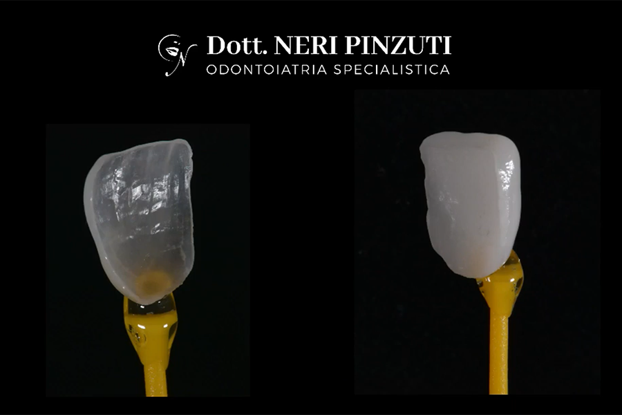 Differenze fra Faccette Dentali Artiginali e Industriali | Neri Pinzuti